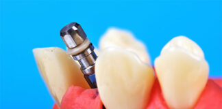 implant zębów