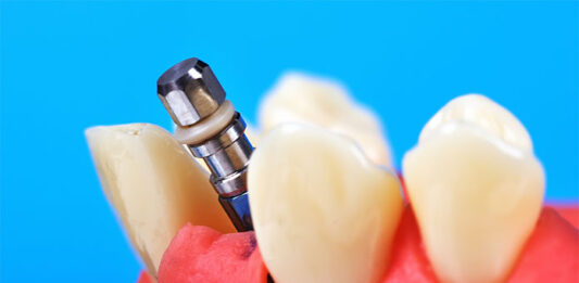 implant zębów
