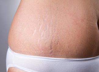 Usuwanie rozstępów – 3 popularne i skuteczne zabiegi wykonywane w salonach kosmetycznych Usuwanie rozstępów – 3 popularne i skuteczne zabiegi wykonywane w salonach kosmetycznych